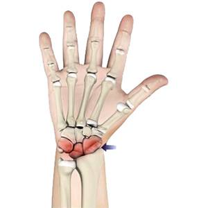 Picture of Arthritis of the Hand and Wrist