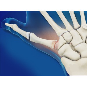 Picture of Arthritis of the Thumb