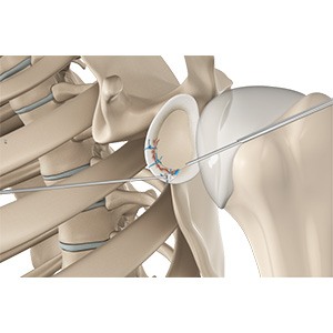 Picture of Arthroscopic Bankart Repair