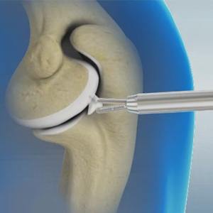 Picture of Arthroscopic Debridement of the Elbow