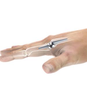 Picture of Artificial Finger Joint Replacement