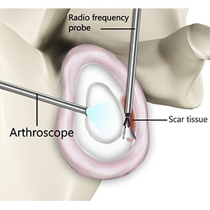 Picture of Capsular Release