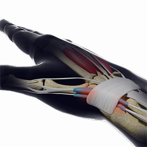 Picture of De Quervain's Tendinosis