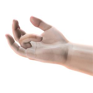Picture of Dupuytren's Contracture