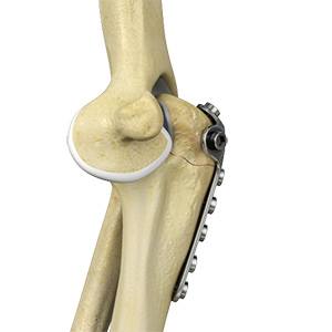 Picture of Elbow Fracture Reconstruction