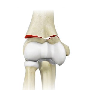 Picture of Elbow Fractures