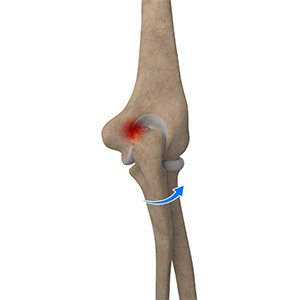 Picture of Elbow Impingement