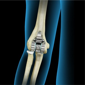 Picture of Elbow Joint Replacement