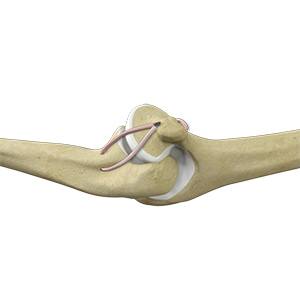 Picture of Elbow Ligament Reconstruction