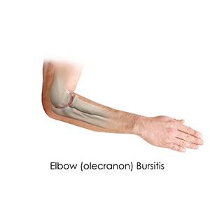 Picture of Elbow Osteoarthritis