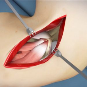 Picture of Elbow Surgery