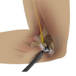 Picture of Endoscopic Cubital Tunnel Release
