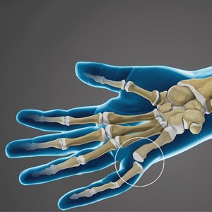 Picture of Finger Dislocation