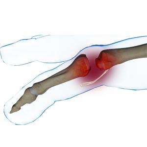 Picture of Finger Joint Dislocation and Volar Plate Injury