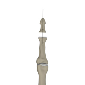 Picture of Finger Joint Fusion