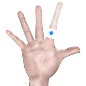 Picture of Finger Replantation