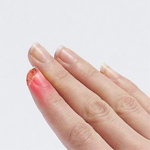 Picture of Fingertip Injuries