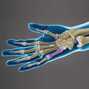 Picture of Fractures of the Hand and Fingers