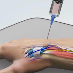 Picture of Ganglion Cyst Removal