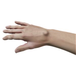 Picture of Ganglion Cyst