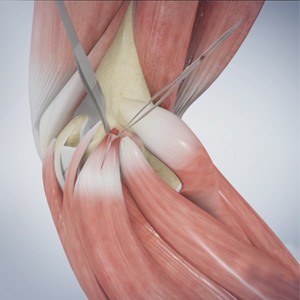 Picture of Golfer's Elbow Surgery