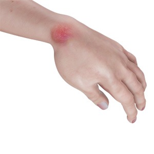 Picture of Hand Infections