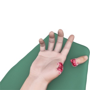 Picture of Industrial Hand Trauma