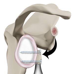 Picture of Latarjet Procedure