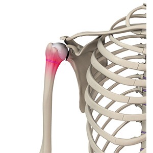 Picture of Little League Shoulder