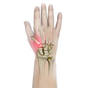 Picture of LRTI for Thumb CMC Arthritis