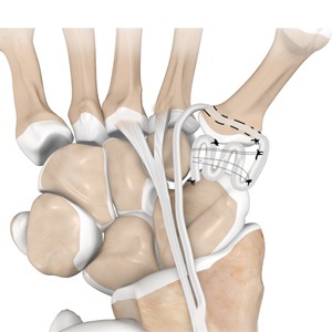 Picture of LRTI (Ligament Reconstruction and Tendon Interposition) for Thumb CMC Arthritis