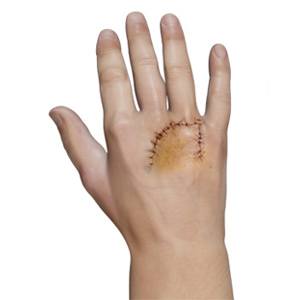 Picture of Microsurgical Flap Procedure of the Hand