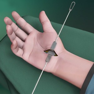 Picture of Open Carpal Tunnel Release Surgery