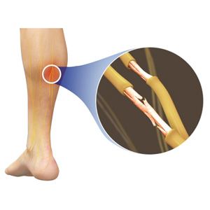Picture of Peripheral Neuropathy