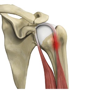 Picture of Proximal Biceps Tendonitis