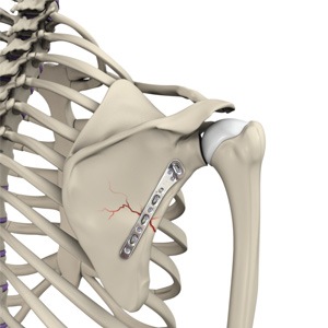 Picture of Shoulder Fracture Care