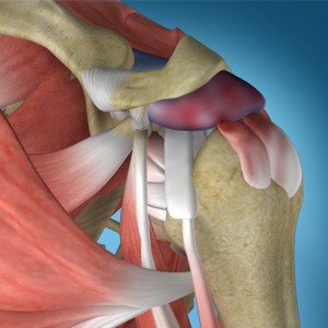 Picture of Shoulder Impingement
