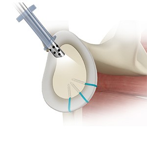 Picture of Shoulder Reconstruction Surgery