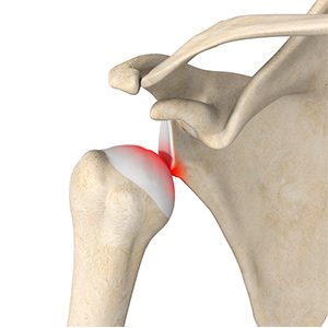Picture of Shoulder Stabilisation
