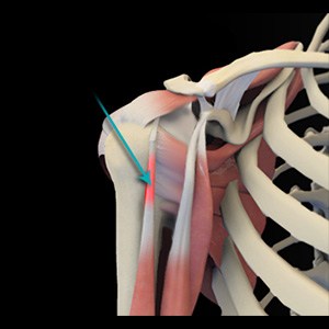 Picture of Shoulder Tendonitis