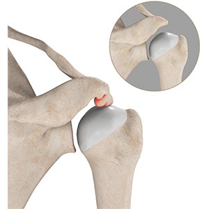 Picture of Subacromial Decompression