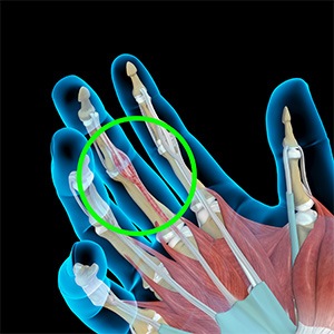 Picture of Tendonitis