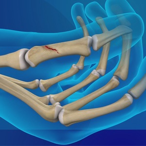 Picture of Thumb Fracture