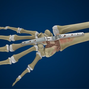 Picture of Total Wrist Fusion