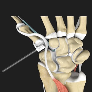 Picture of Trapeziectomy