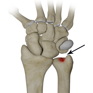 Picture of Ulnar Wrist Pain