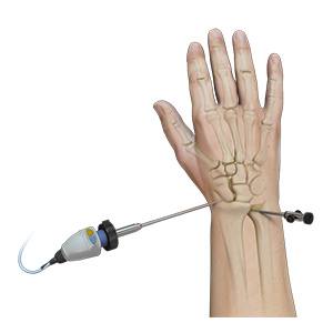 Picture of Wrist Arthroscopy