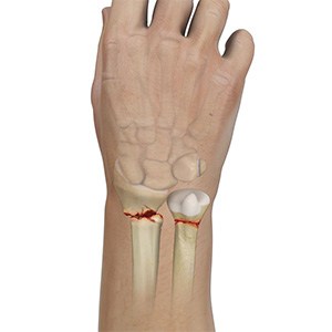 Picture of Wrist Fracture