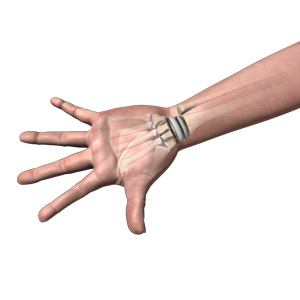 Picture of Wrist Joint Replacement