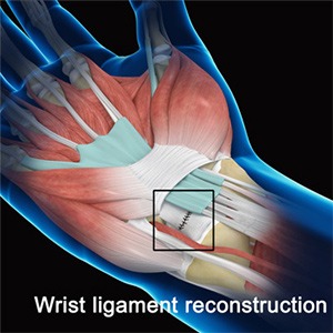 Picture of Wrist Ligament Reconstruction